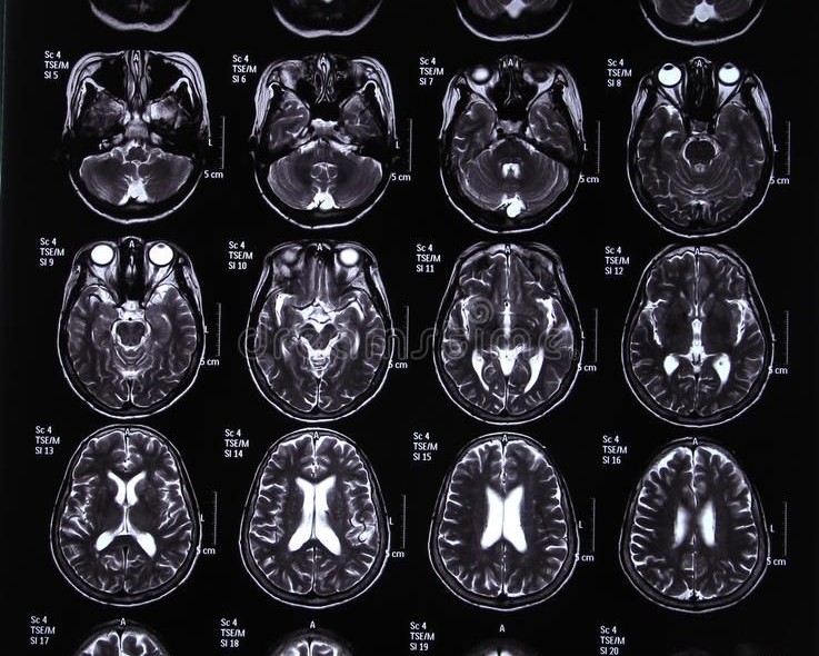 Brain CT scan showing tumor classification